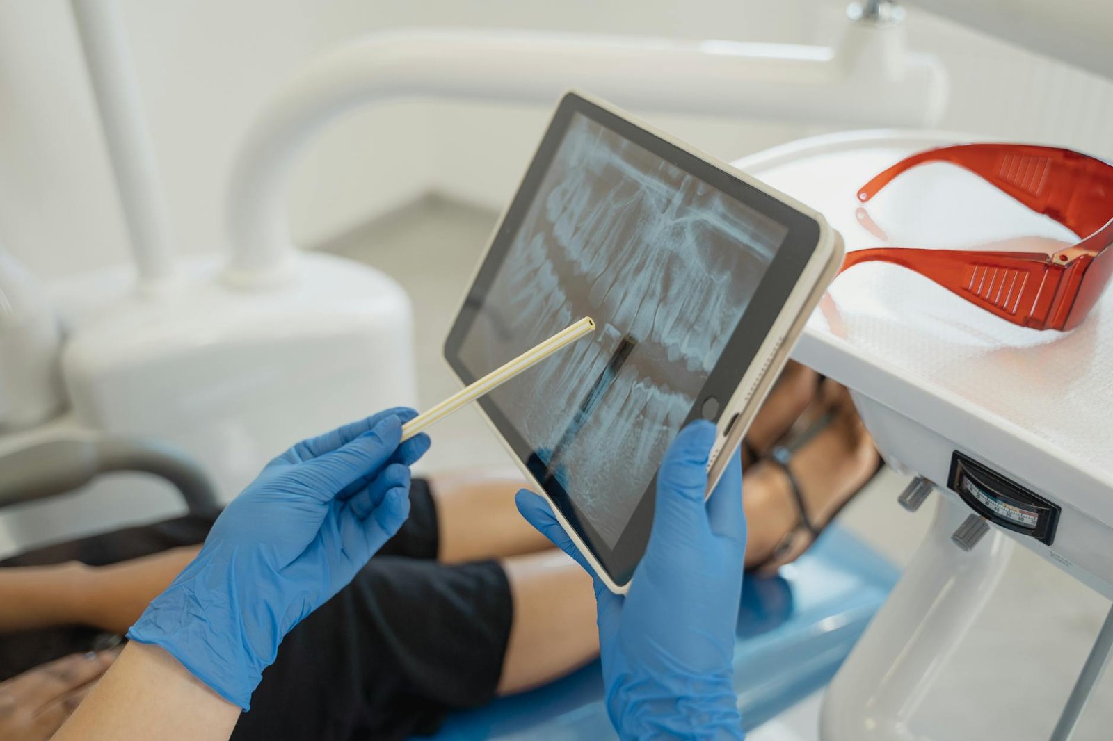 Illustration of Root Canal Hyderabad: Affordable & Must-Have Tooth Pain Treatment Guide